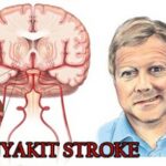 “Stroke dan Dampaknya: Dari Serangan Tiba-Tiba hingga Pemulihan Panjang”