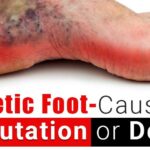 Ancaman Amputasi pada Penderita Kencing Manis akibat Diabetic Foot
